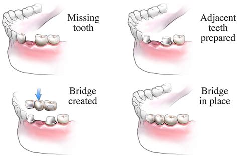 Dental Bridge Procedure