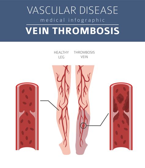 Deep Vein Thrombosis (DVT): Symptoms, Causes, & Treatment