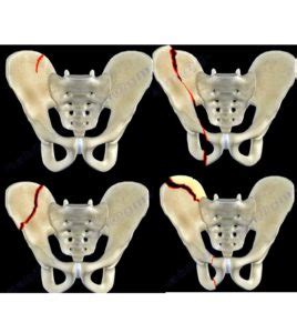 Iliac Wing Fractures — OrthopaedicPrinciples.com