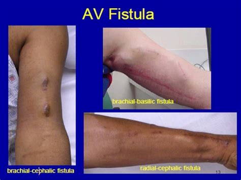 Arteriovenous Fistula - For Dialysis, Dural, Symptoms