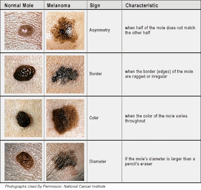 Melanoma Cancer: Skin Cancer Photos Melanoma