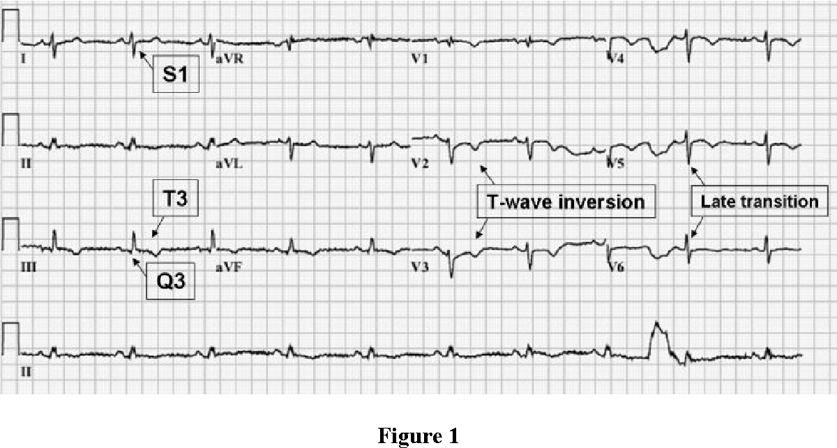 Pulmonary Embolism ECG Changes