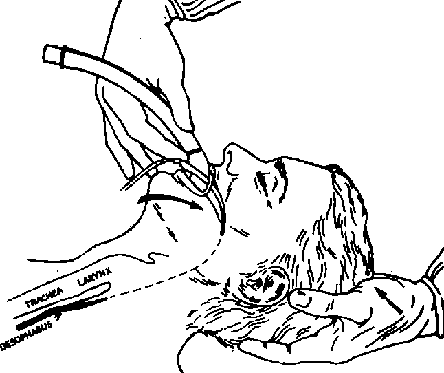 Figure 3-12 from Airway-Management Adjuncts PLACEMENT OF AIRWAY DEVICES ...