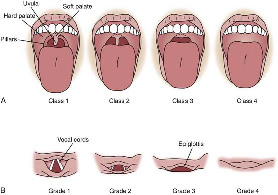 Grade 1 View Intubation