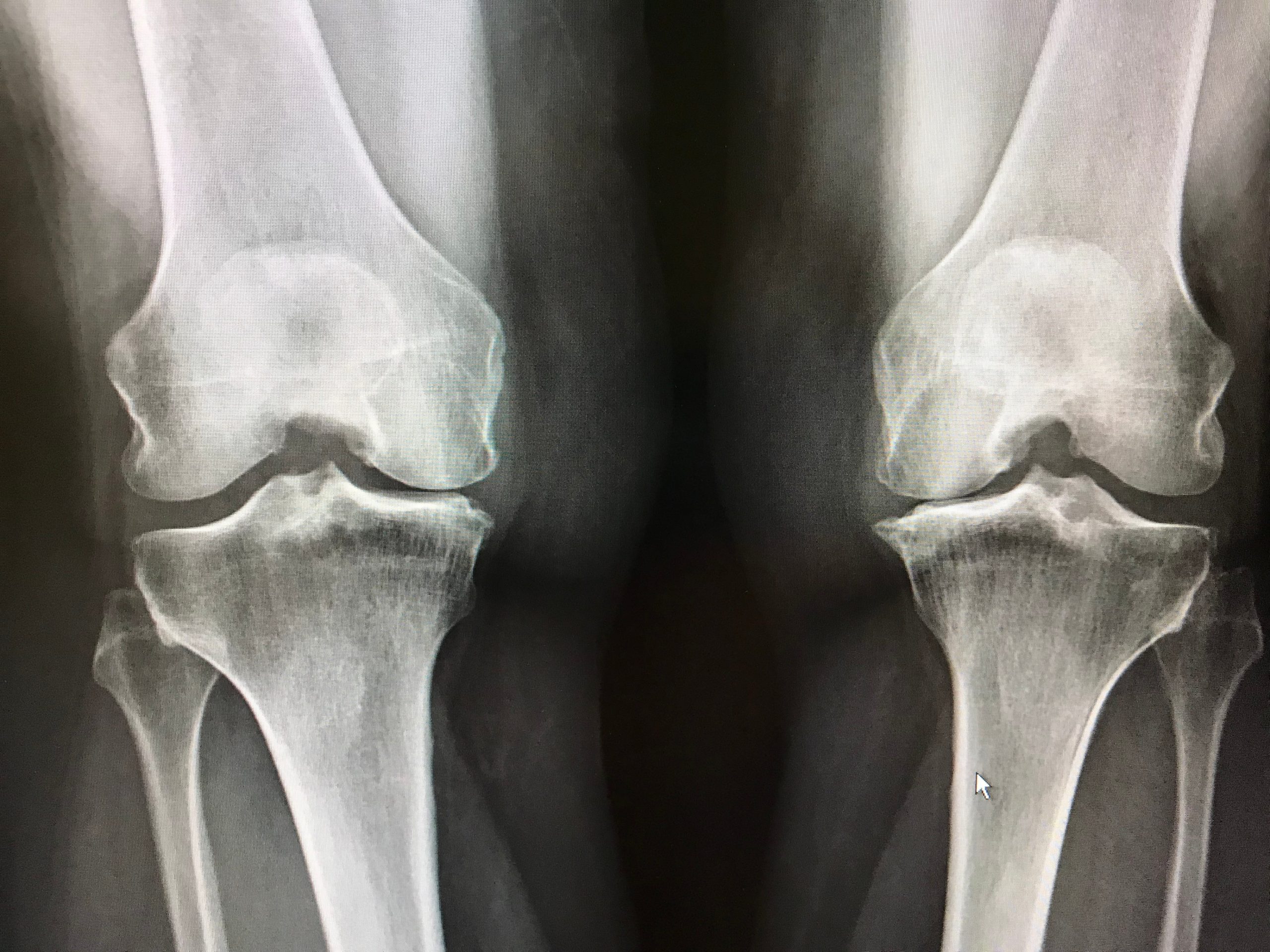 Knee AP View X-ray - Aarthi Scans and Labs