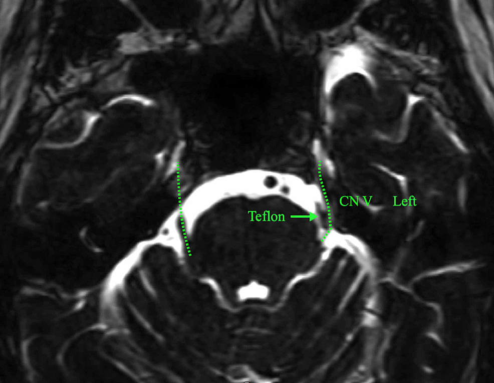 Cureus | Multiple Recurrences of Trigeminal Neuralgia Caused by ...