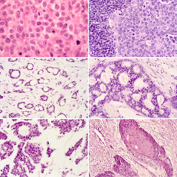 Invasive Ductal Carcinoma Histology