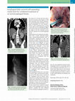 Research paper thumbnail of Esophageal fully covered self-expanding metal stent for combined treatment of an aortoesophageal fistula