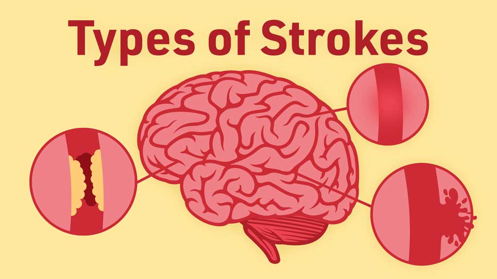 Cover image for: Different Types of Stroke