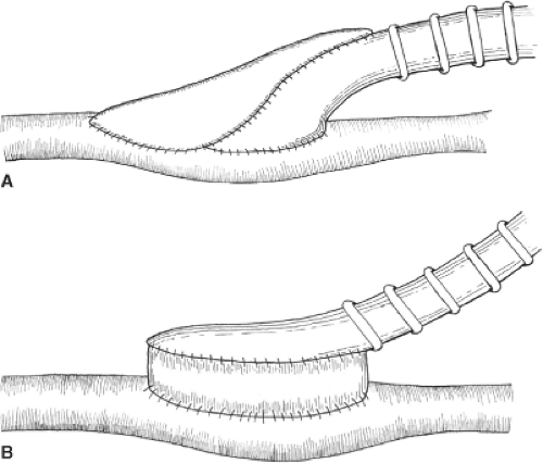 Femoral Peroneal Bypass