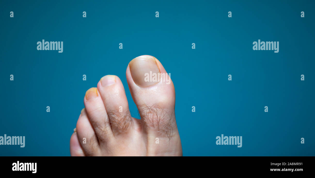 Extreme close up view of toenail infection on hairy man foot Stock Photo