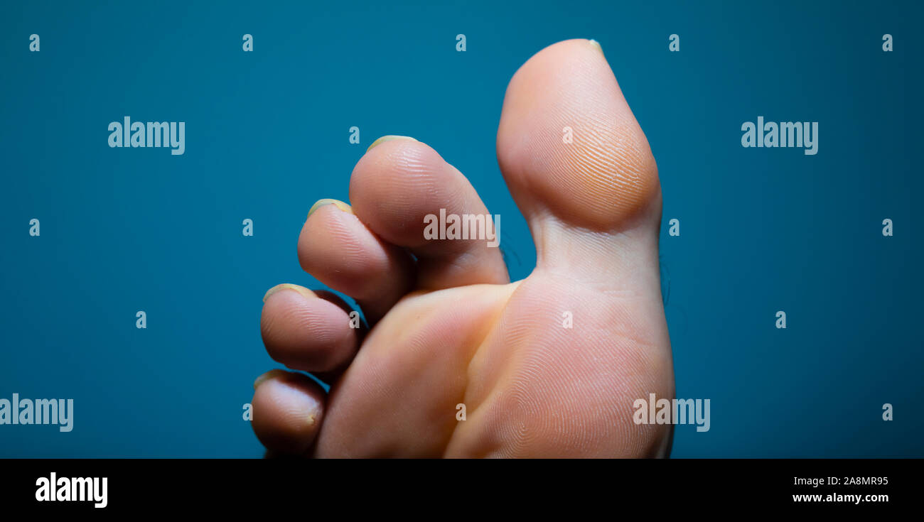 Extreme close up of athlete foot fungus infection seen from below Stock Photo