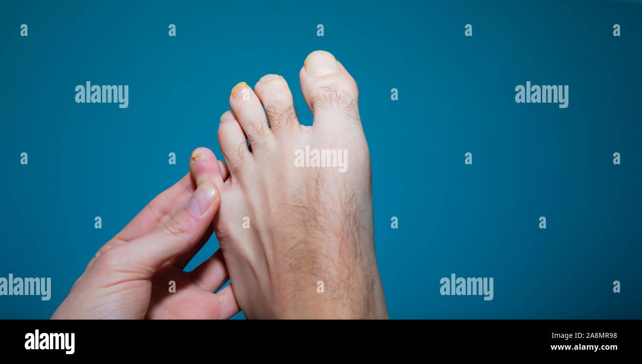 Close up on athlete foot toenail fungus infection Stock Photo