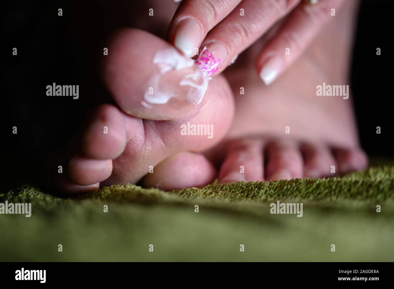 Fingers appling lotion on foot with fungal infection. Althele's foot can cause serious itching, blisters, reddness and smelly feets Stock Photo