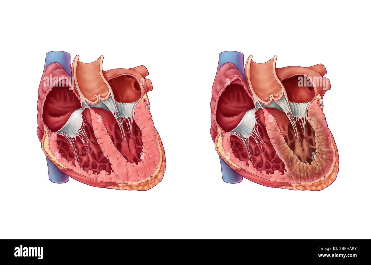 Restrictive cardiomyopathy hi-res stock photography and images - Alamy