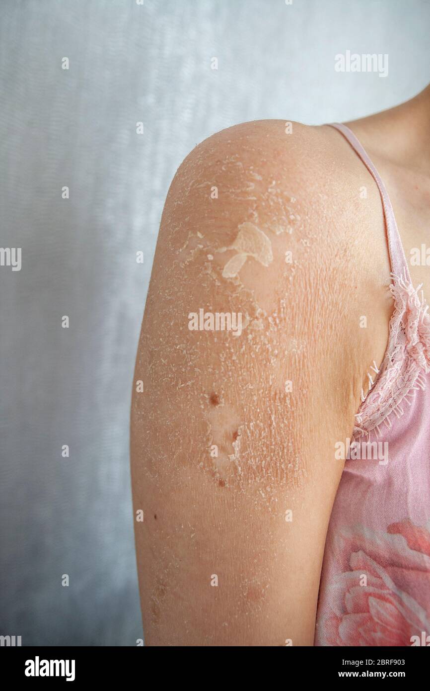 Close up of Eczema (Dermatitis), Allergy, Psoriasis, Fungal, Dry or Burned skin. Close up of the Woman Shoulder. Health care concept. Stock Photo