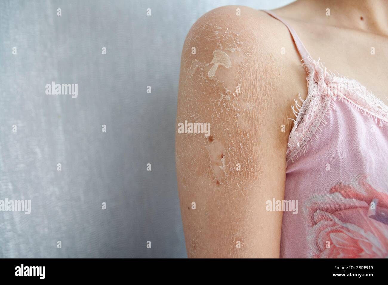 Close up of Eczema (Dermatitis), Allergy, Psoriasis, Fungal, Dry or Burned skin. Close up of the Woman Shoulder. Health care concept. Stock Photo