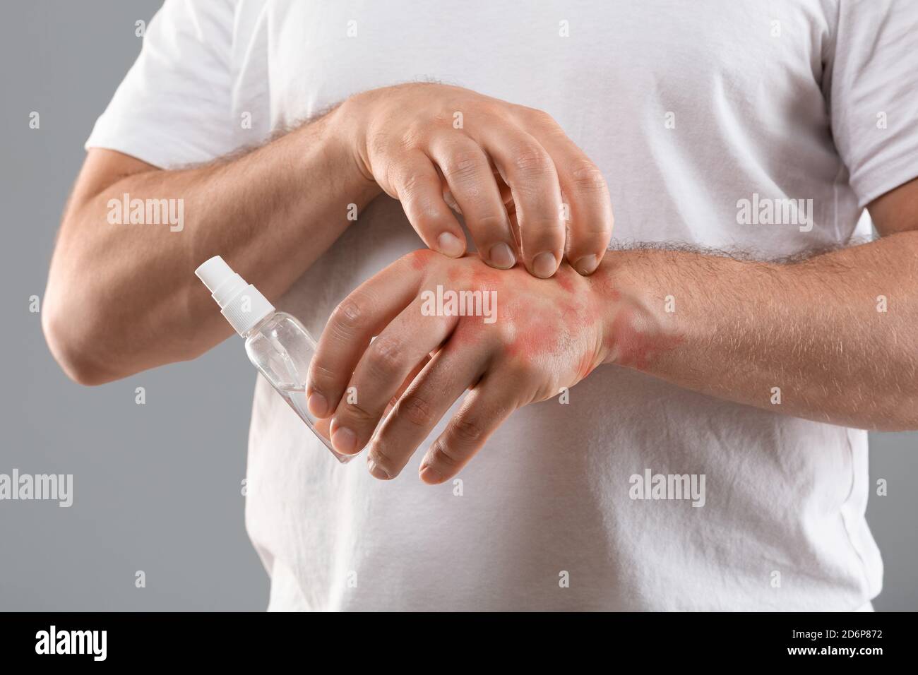 Unrecognizable man scratching itch on his hand Stock Photo