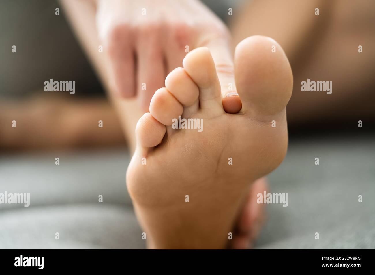 Athlete Foot Fungal Infection. Itching Between Toes Stock Photo