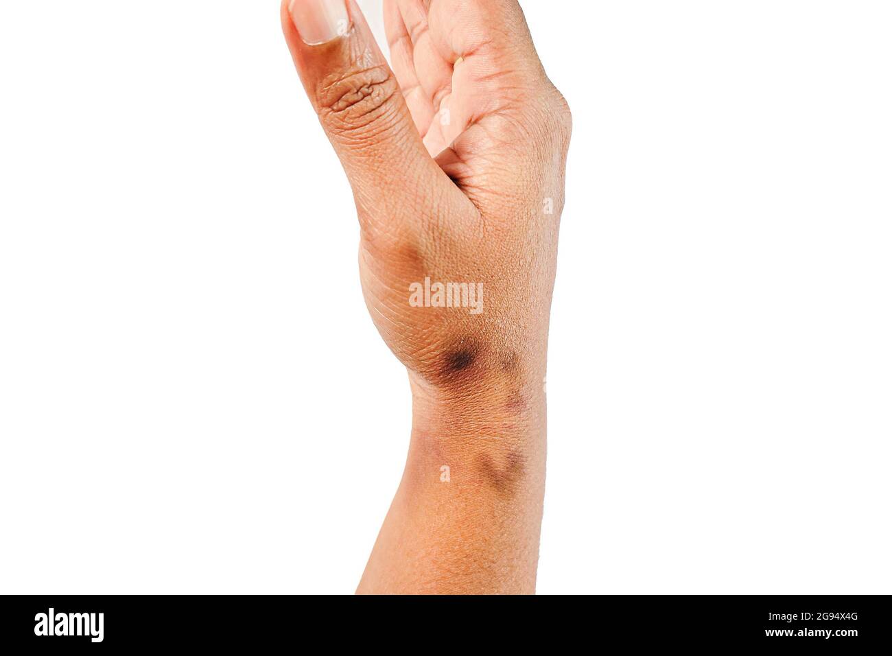 dry, dehydrated close up view of asian women hand with multiple deep black marks dermatitis problem of rash ,Allergy rash Stock Photo