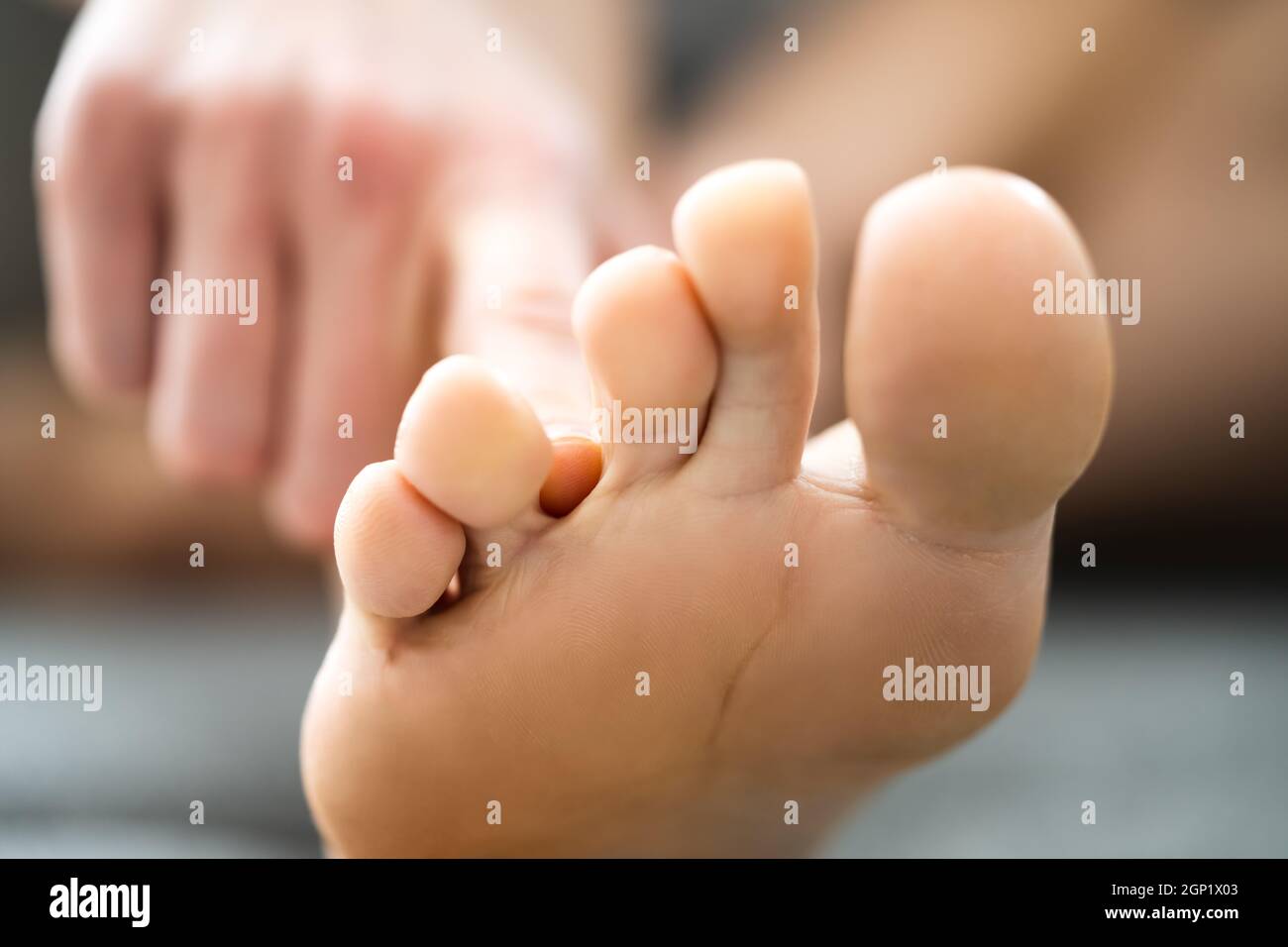 Athlete Foot Fungal Infection. Itching Between Toes Stock Photo