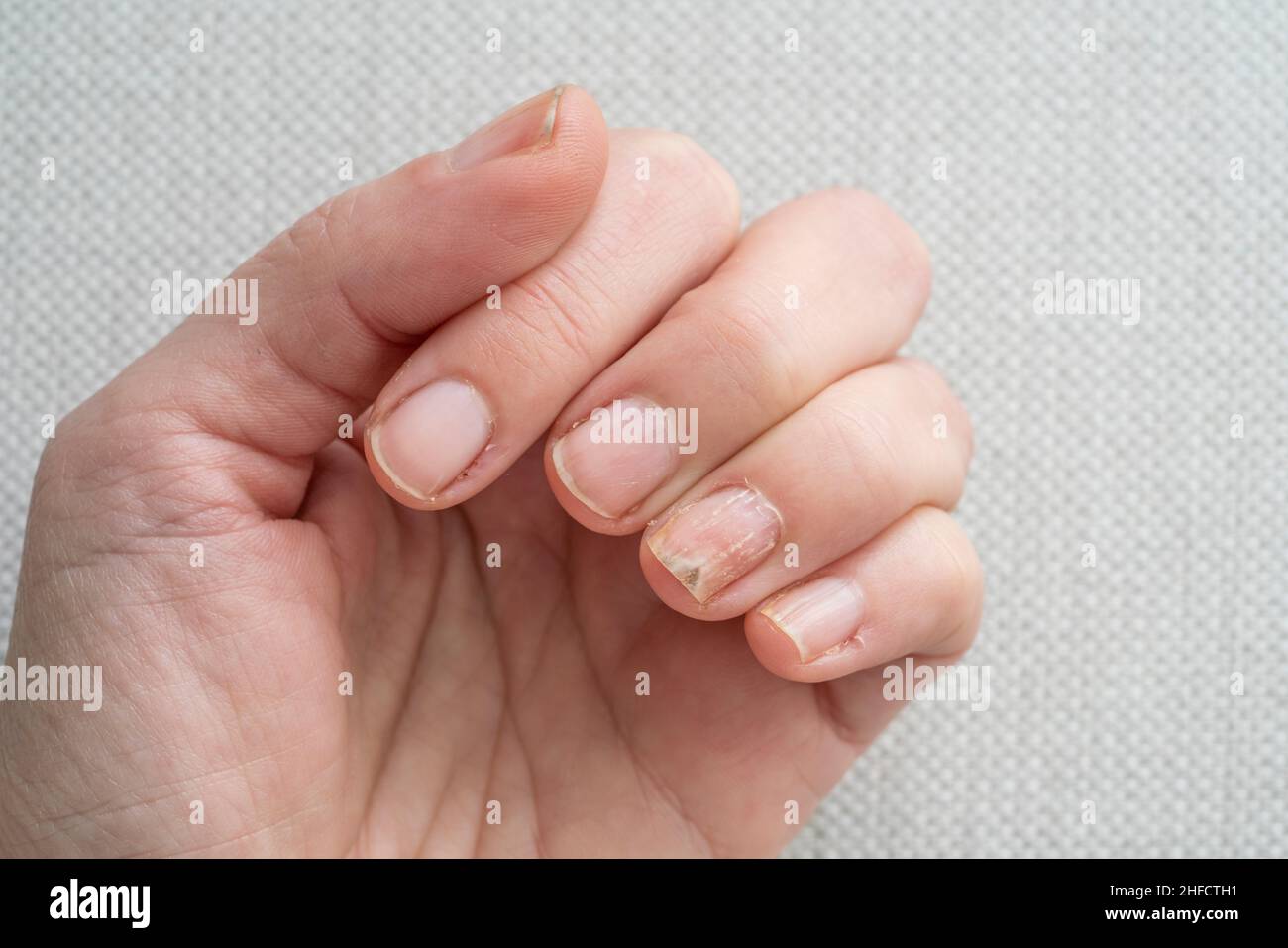 Fungus, Closeup nail fungus infection on hand finger of white caucasian woman. Fungal infection on nail, female hand finger with onychomycosis. health Stock Photo