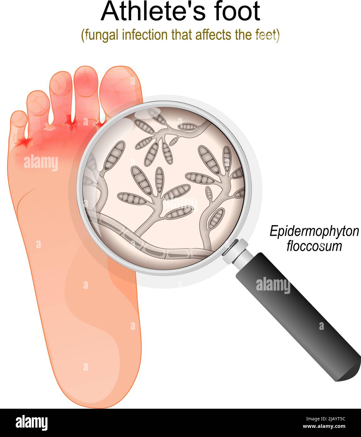 Athlete's foot. fungal infection that affects the feet. Close-up of Epidermophyton floccosum fungi. vector illustration Stock Vector