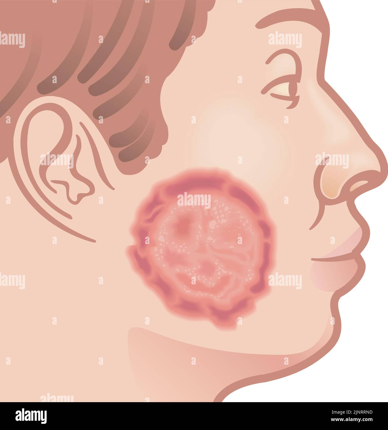 Medical illustration of a male face suffering from ringworm. Stock Vector