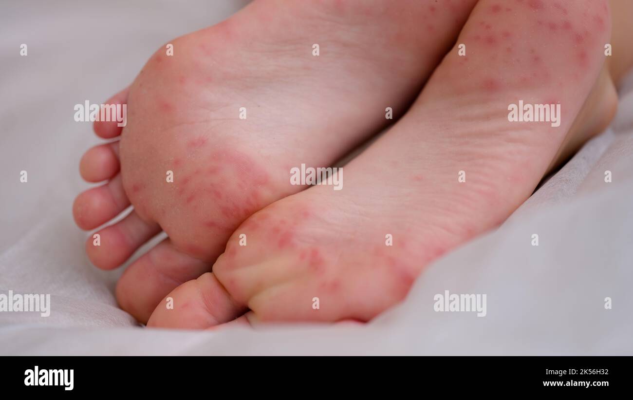 Painful rash red spots blisters on child leg Stock Photo