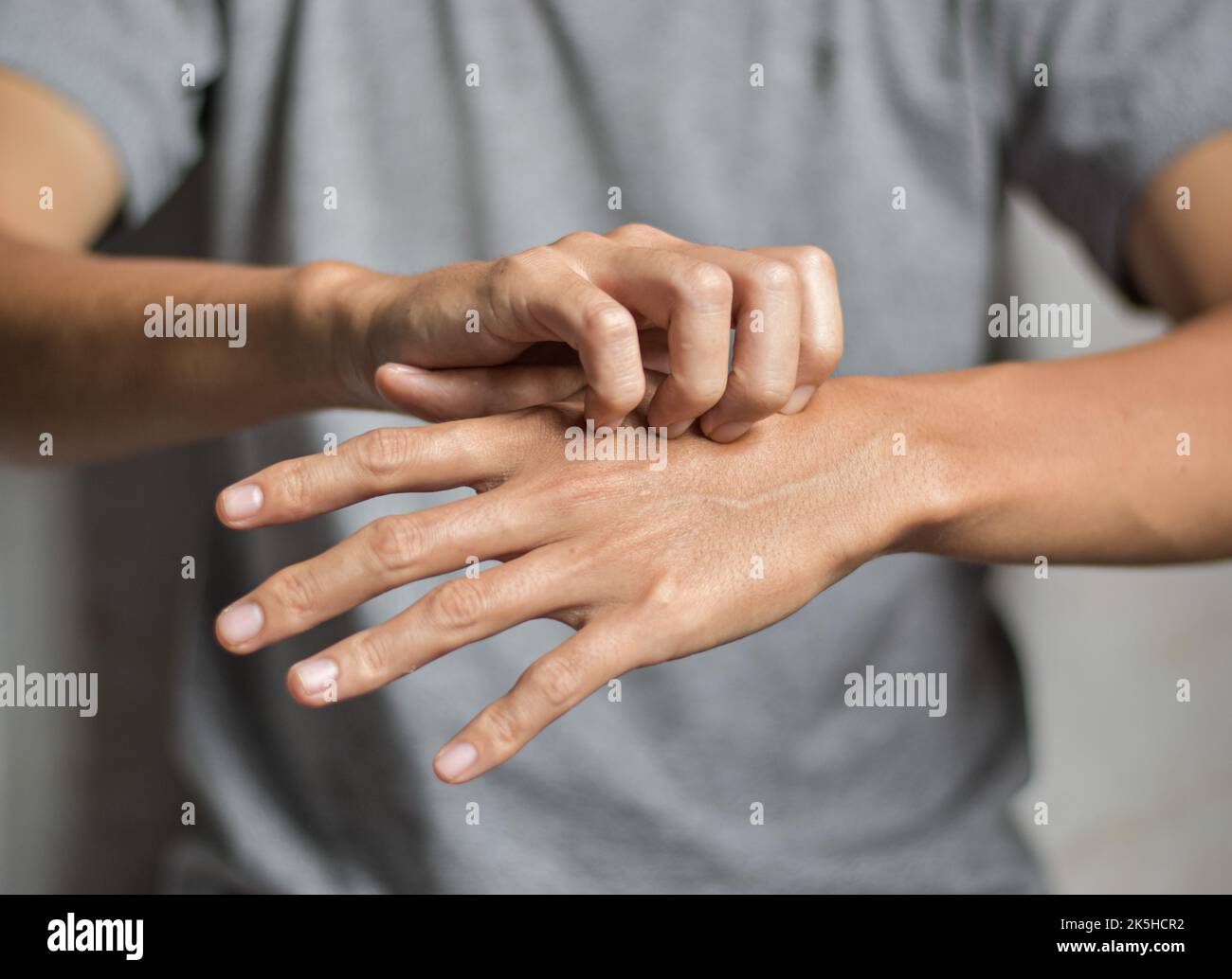 Asian young man scratching his hand. Concept of itchy skin diseases such as scabies, fungal infection, eczema, psoriasis, rash, allergy, etc. Stock Photo