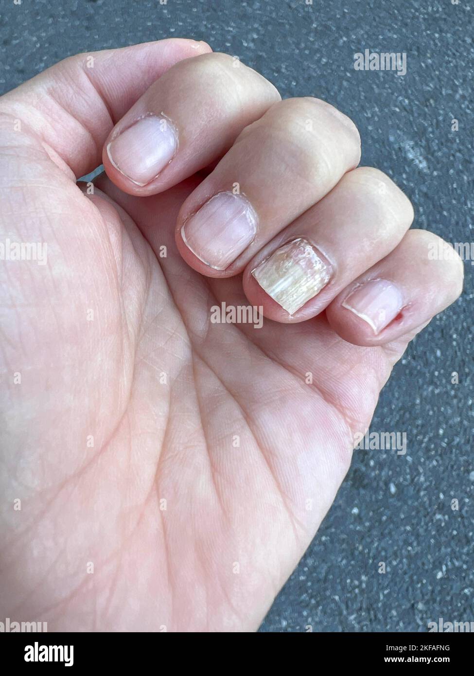 Fungus, Closeup nail fungus infection on hand finger of caucasian woman. Fungal infection on nail, female hand finger with onychomycosis. health care. Stock Photo