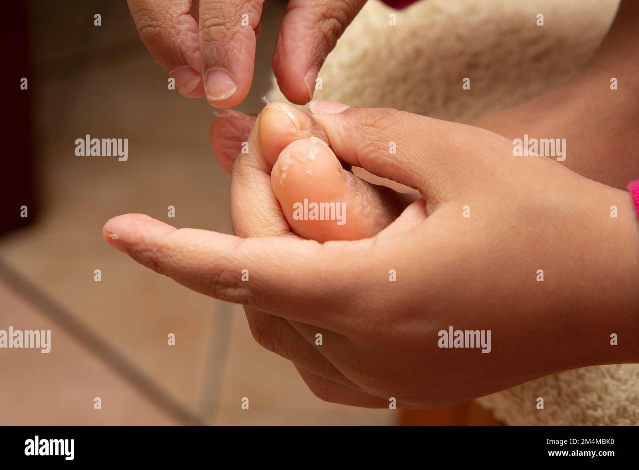 Dermatitis in the feet and hands of a teenager peeling skin from his big toe. Athlete's foot due to poor sanitation and fungal infection Stock Photo