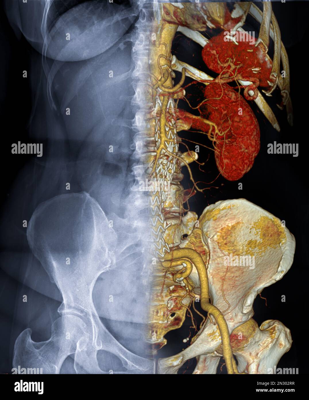 CTA ABDOMINAL AORTA  3D rendering fusion with  X-ray Abdomen image. Stock Photo