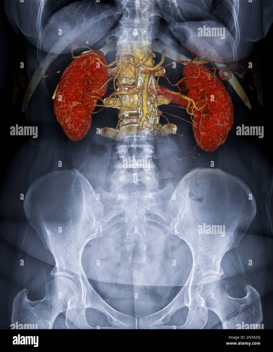 CTA ABDOMINAL AORTA  3D rendering fusion with  X-ray Abdomen image. Stock Photo