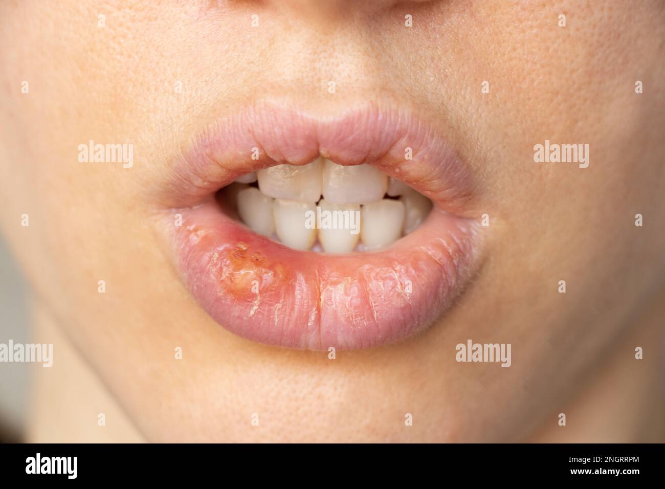 Simplex herpes on the lips of a girl close-up, a group of viral diseases with a characteristic rash of grouped vesicles on the lip Stock Photo