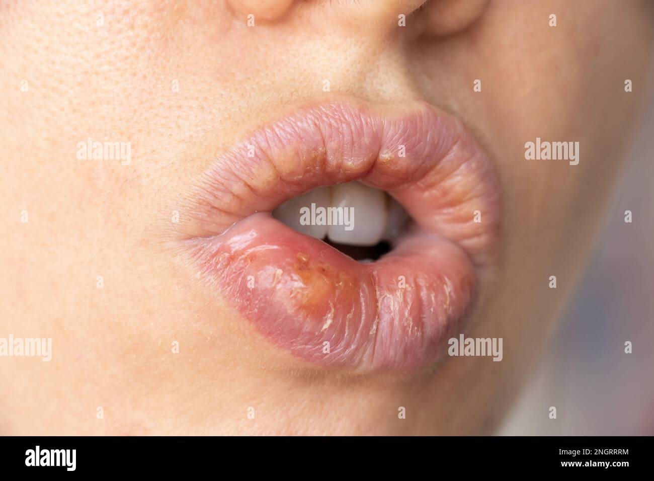 Simplex herpes on the lips of a girl close-up, a group of viral diseases with a characteristic rash of grouped vesicles on the lip Stock Photo