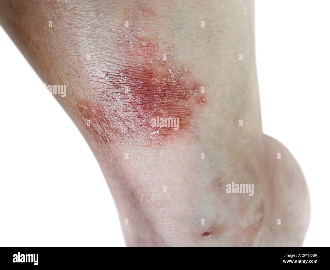 Close up dermatitis on skin, ill allergic rash dermatitis eczema skin of patient , atopic dermatitis symptom skin detail texture , Fungus of skin ,The concept dermatology, treatment fungal and fungal Stock Photo