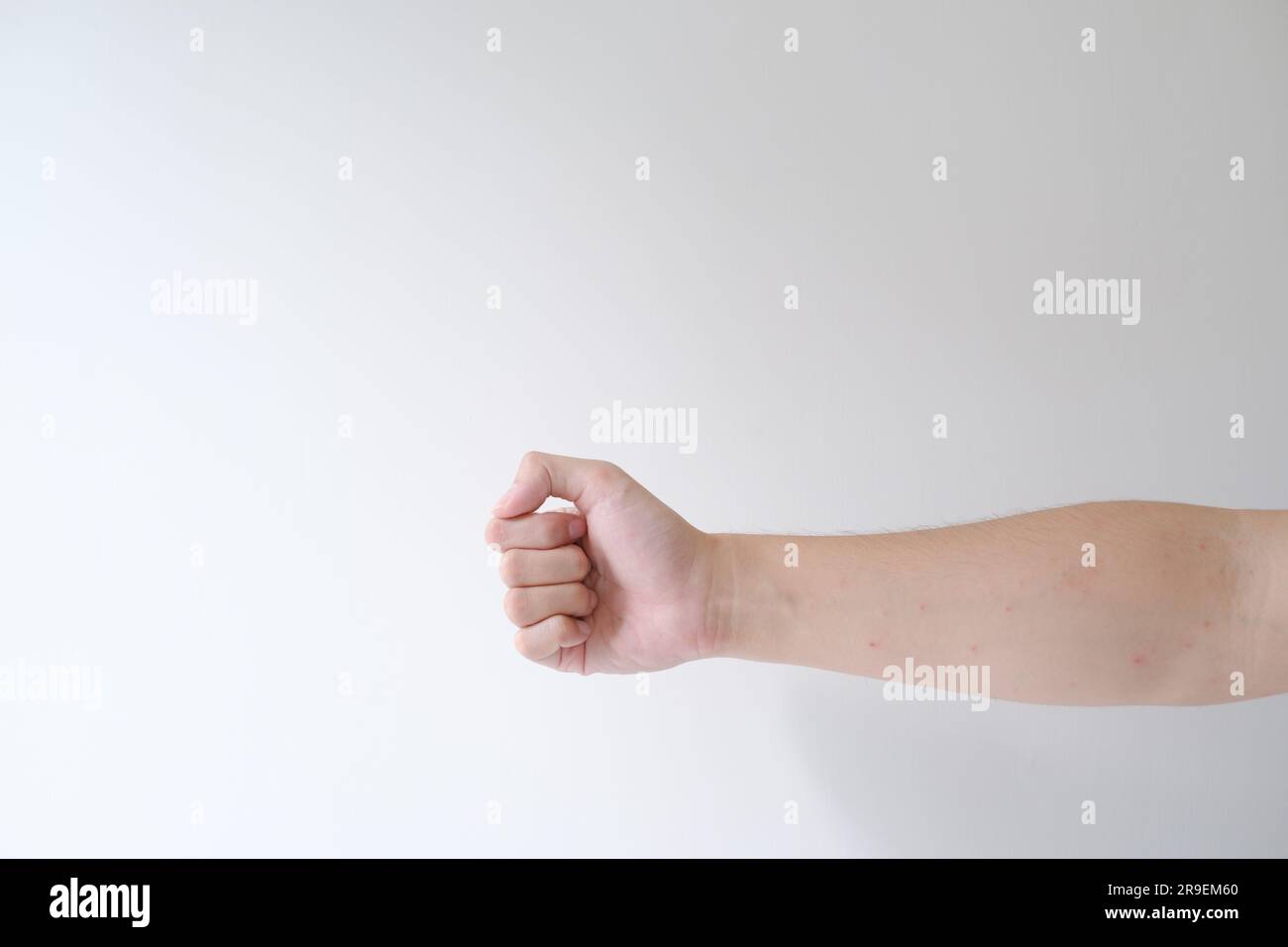 The hand of a man with a lot of red spots. Isolated white background. Stock Photo