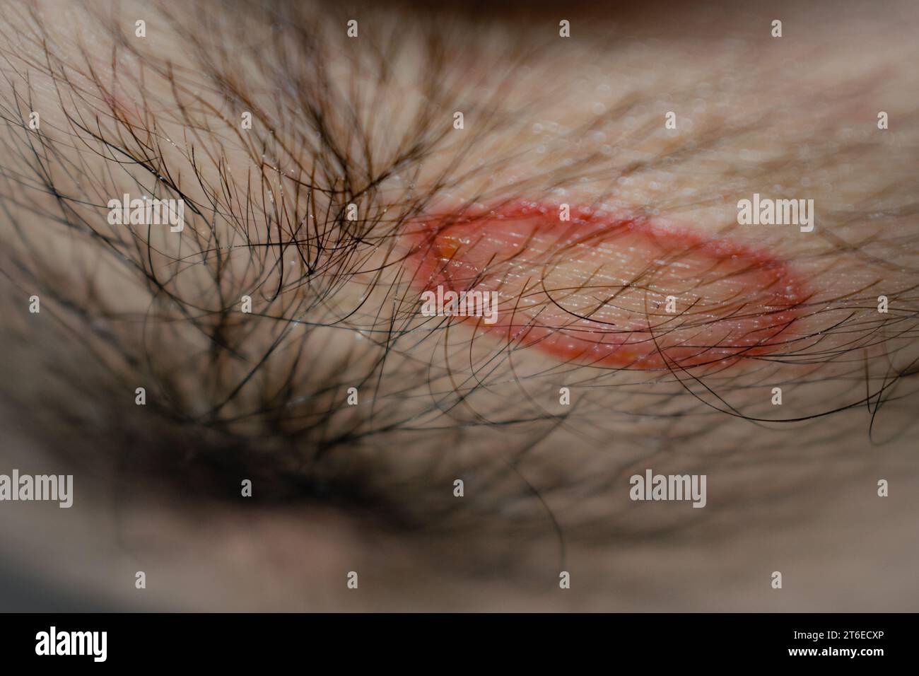 Detailed Close-Up of Ringworm (Tinea) Fungal Infection on Human Skin – High-Resolution Image Depicting the Distinctive Red, Circular Rash and Scaling Common to Dermatophytosis; Useful for Medical, Dermatology, and Health Education Purposes in Illustrating Skin Conditions, Symptoms, Causes, Prevention, and Treatment Options for Ringworm and Other Fungal Infections. Stock Photo