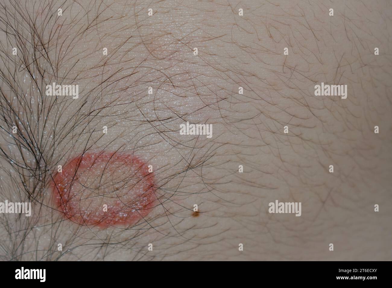 Detailed Close-Up of Ringworm (Tinea) Fungal Infection on Human Skin – High-Resolution Image Depicting the Distinctive Red, Circular Rash and Scaling Common to Dermatophytosis; Useful for Medical, Dermatology, and Health Education Purposes in Illustrating Skin Conditions, Symptoms, Causes, Prevention, and Treatment Options for Ringworm and Other Fungal Infections. Stock Photo