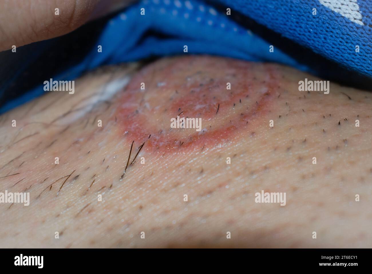 Detailed Close-Up of Ringworm (Tinea) Fungal Infection on Human Skin – High-Resolution Image Depicting the Distinctive Red, Circular Rash and Scaling Common to Dermatophytosis; Useful for Medical, Dermatology, and Health Education Purposes in Illustrating Skin Conditions, Symptoms, Causes, Prevention, and Treatment Options for Ringworm and Other Fungal Infections. Stock Photo