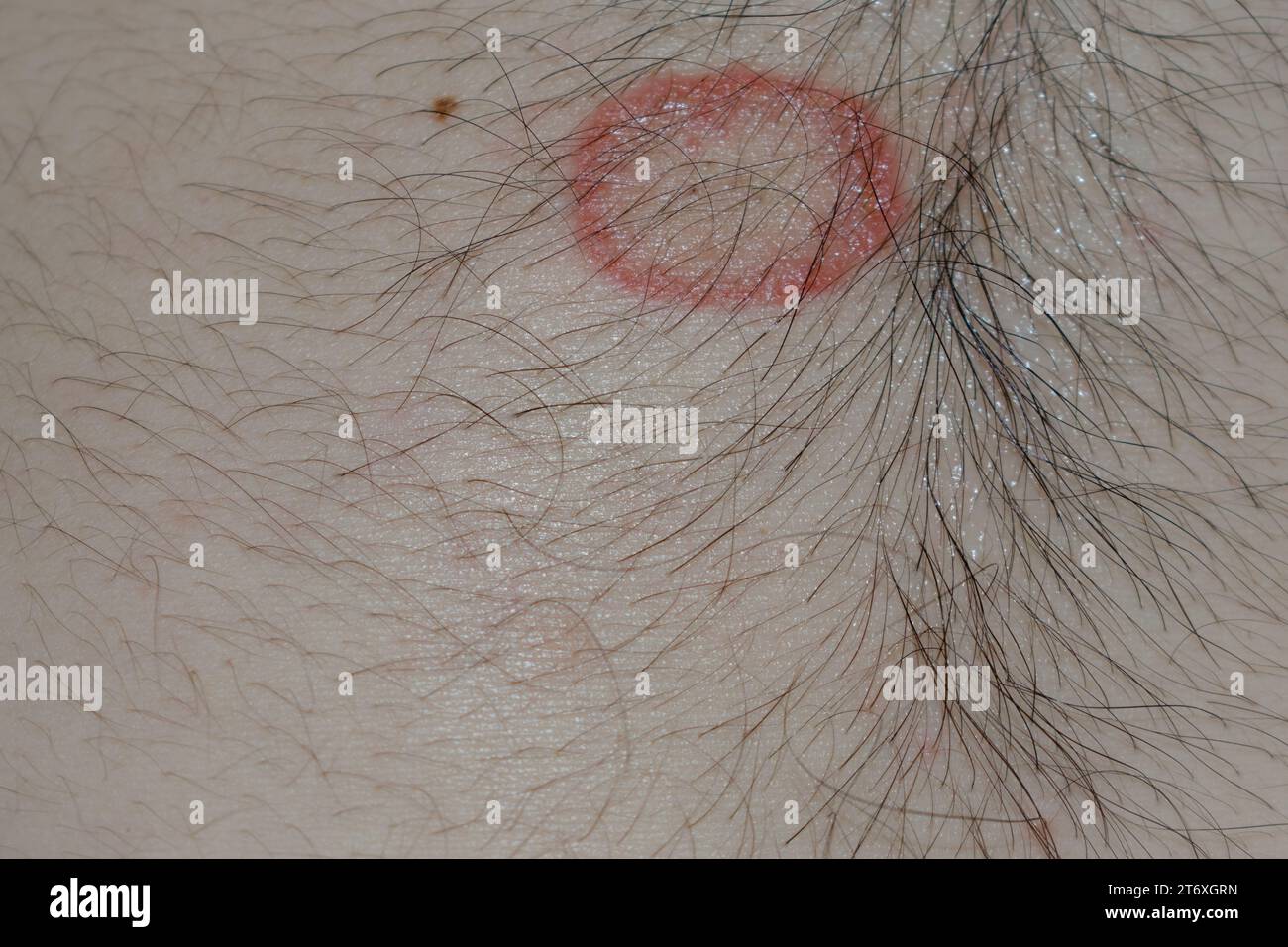 Detailed Close-Up of Ringworm (Tinea) Fungal Infection on Human Skin – High-Resolution Image Depicting the Distinctive Red, Circular Rash and Scaling Common to Dermatophytosis; Useful for Medical, Dermatology, and Health Education Purposes in Illustrating Skin Conditions, Symptoms, Causes, Prevention, and Treatment Options for Ringworm and Other Fungal Infections. Stock Photo