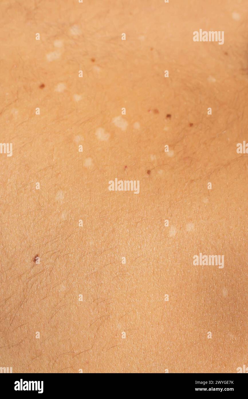 Capture the visual complexity of tinea versicolor, a common fungal skin infection, with this high-resolution stock image Stock Photo