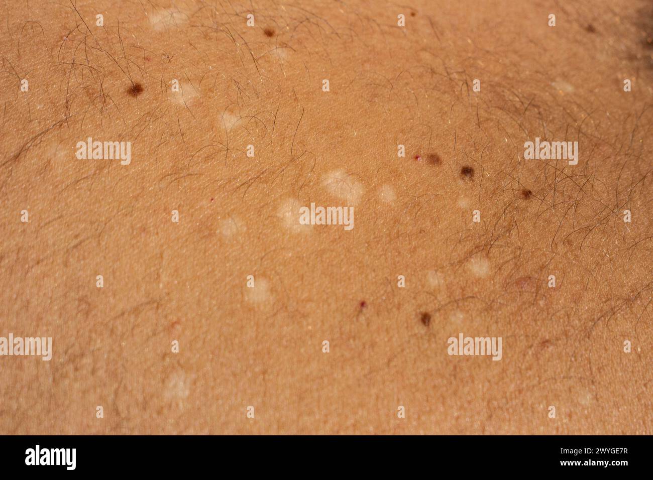 Capture the visual complexity of tinea versicolor, a common fungal skin infection, with this high-resolution stock image Stock Photo