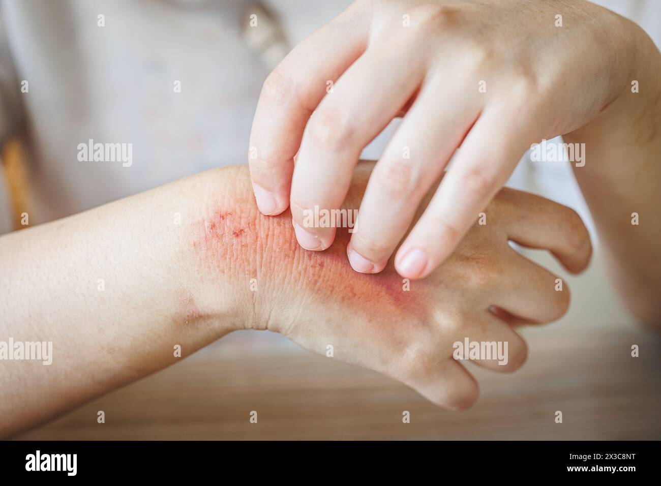 hand itching scratching. Itchy red rash, flea allergies, blister fungal annoying skin diseases Stock Photo