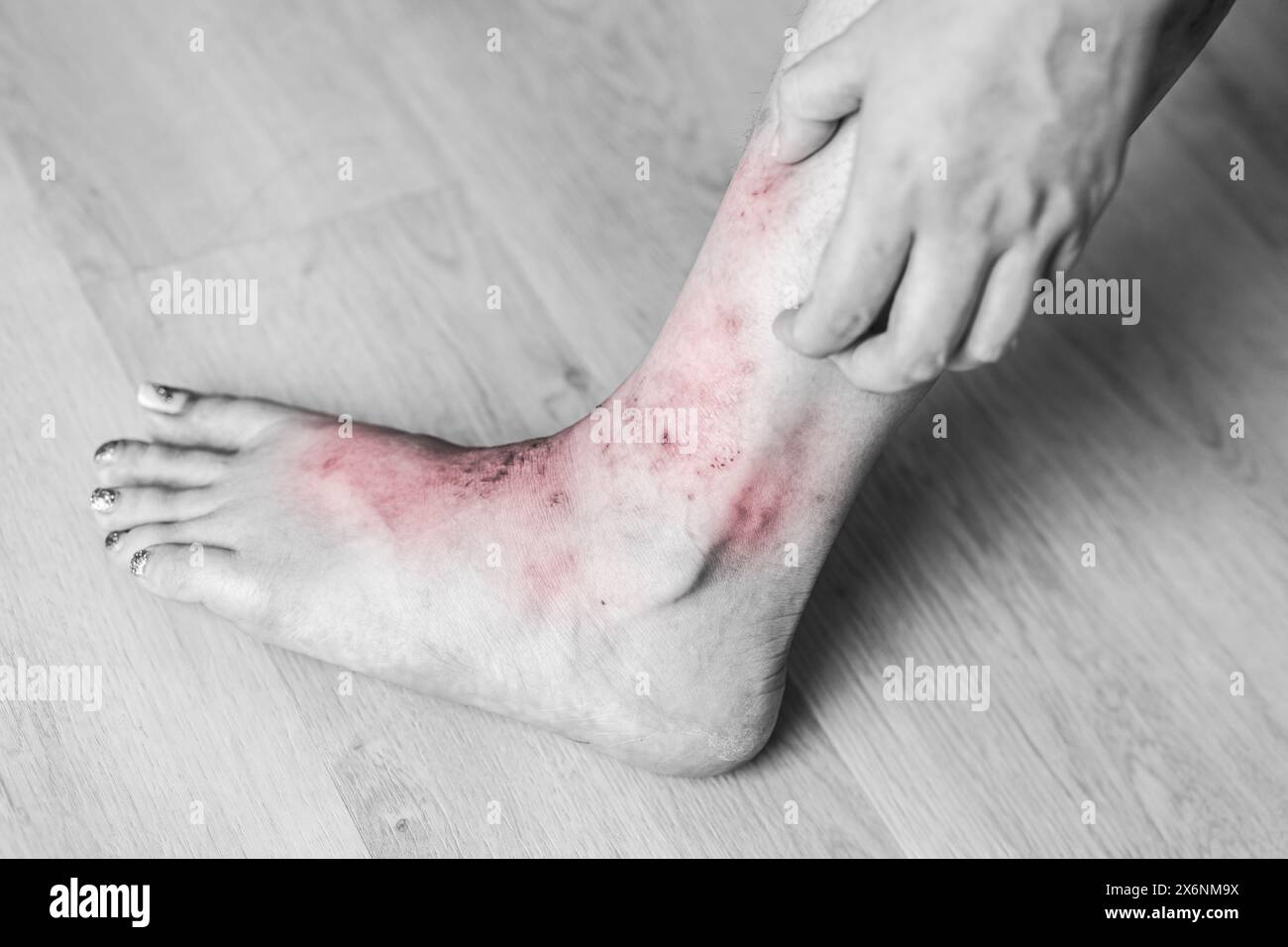 severe leg itching scratching. scary wound Itchy rash, allergies, fungal skin diseases Stock Photo