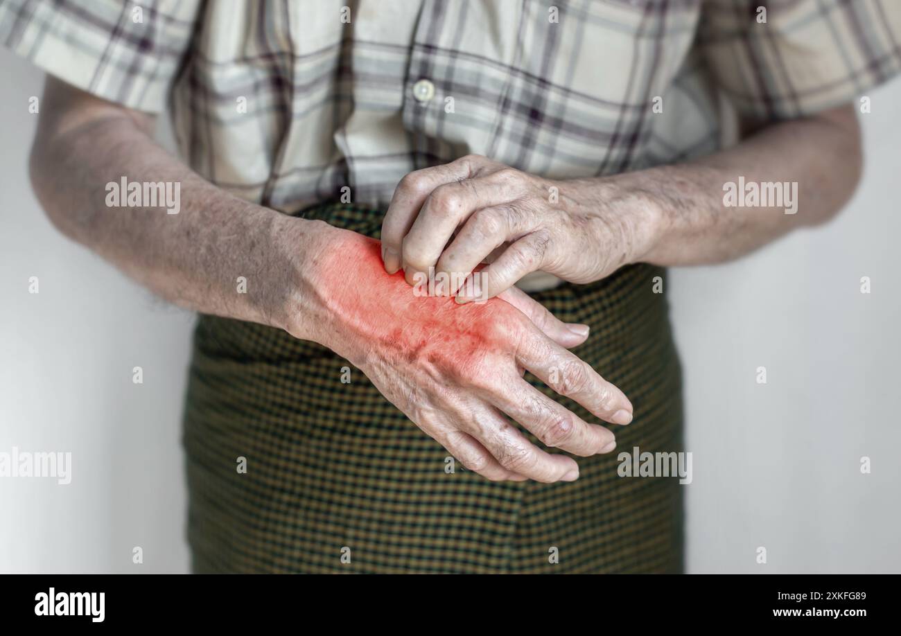 Asian elder man scratching his hand. Concept of itchy skin diseases such as scabies, fungal infection, eczema, psoriasis, rash, allergy, etc. Stock Photo