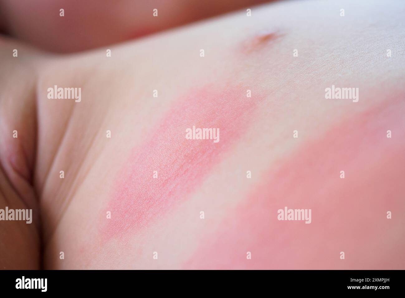 Severe eczema skin rash and allergic reaction symtom at little asian child body cause by hypersensitivity Stock Photo