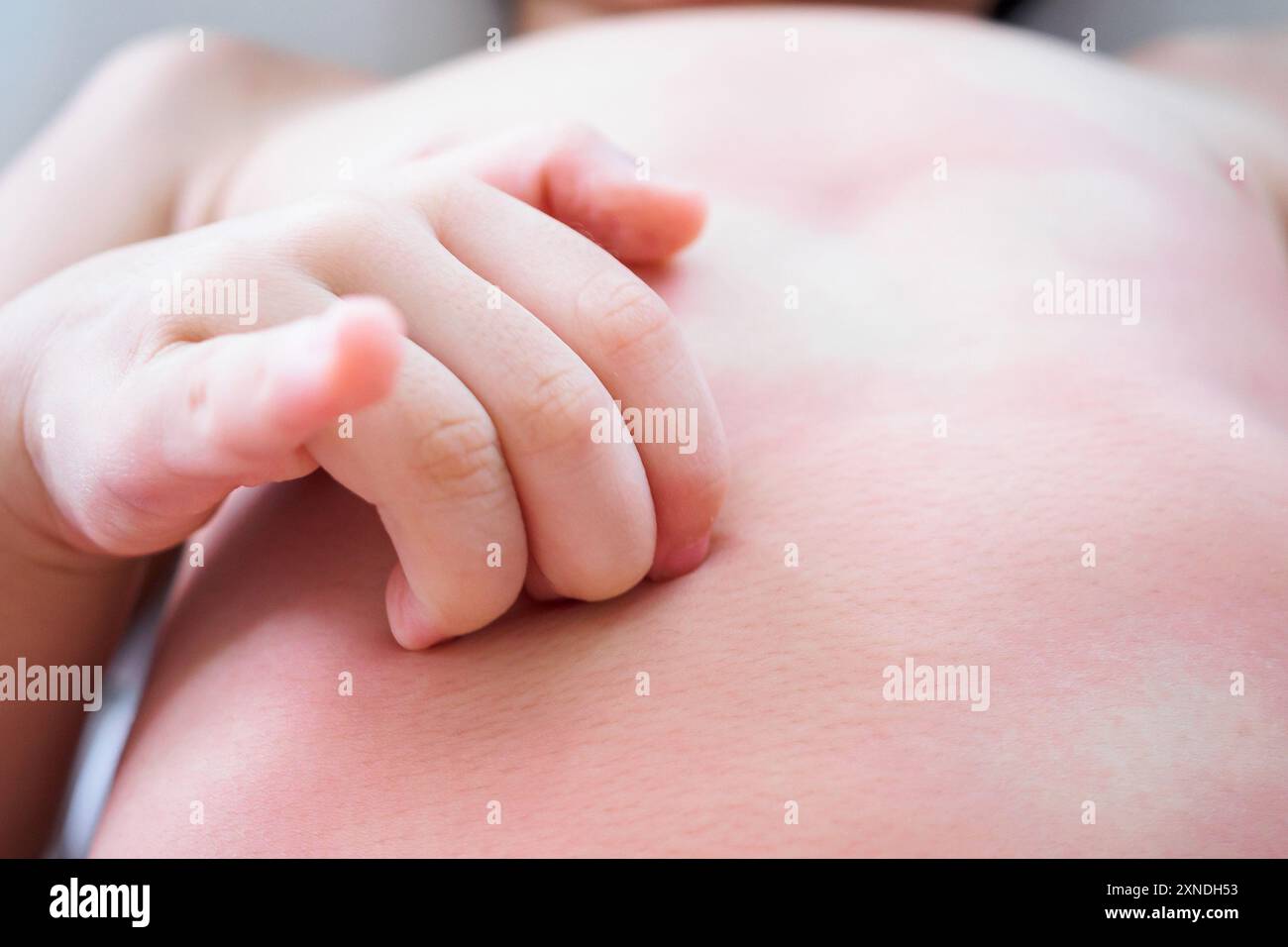 little asian baby girl hand scratch on her body with skin rash itchy and allergy Stock Photo