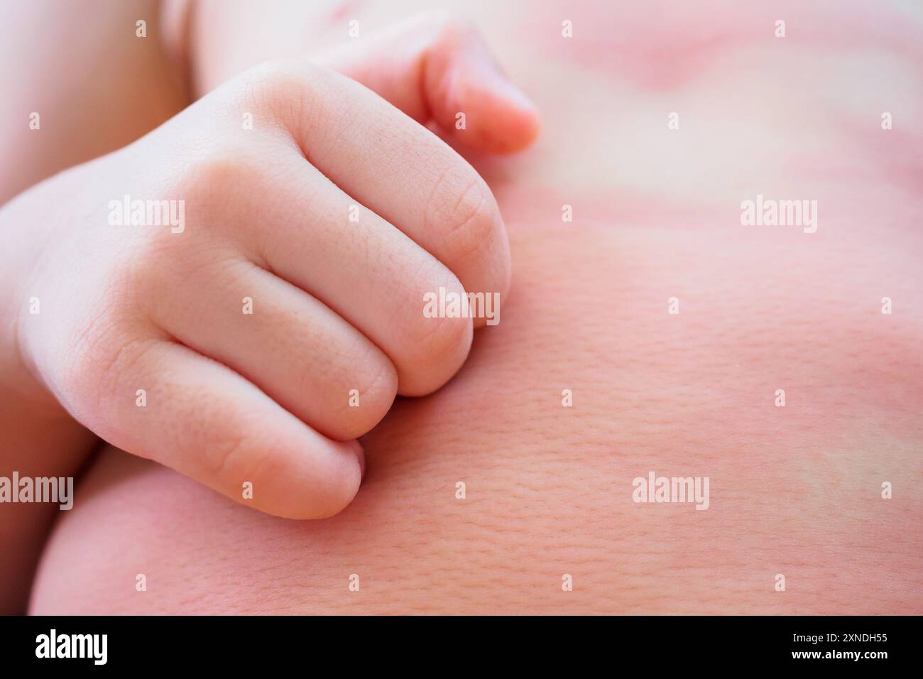 little asian baby girl hand scratch on her body with skin rash itchy and allergy Stock Photo